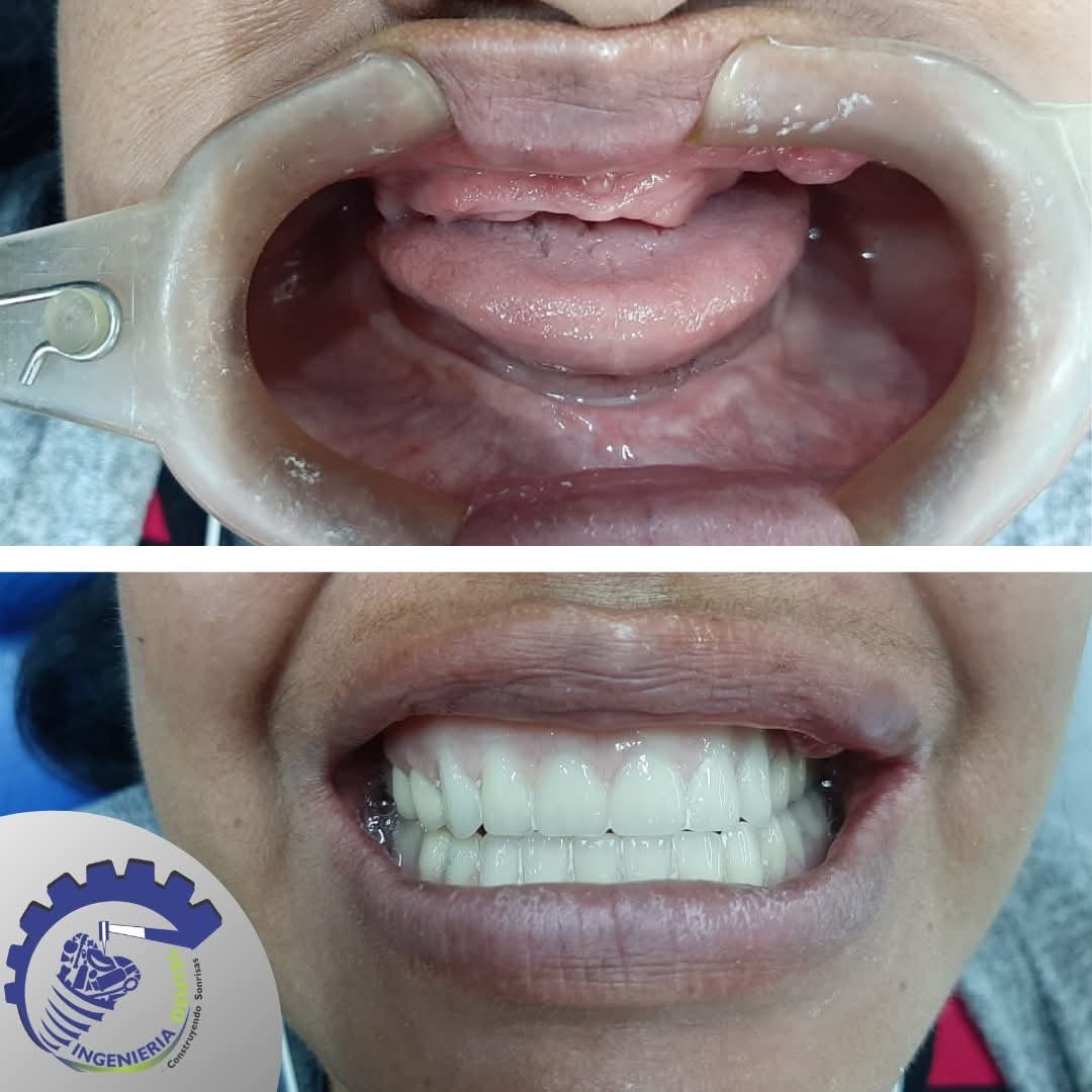 Antes y después: prótesis dental