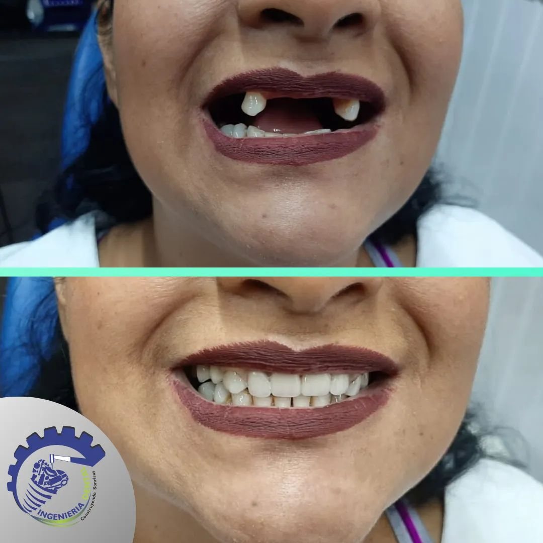 Antes y después: restauración de dientes frontales